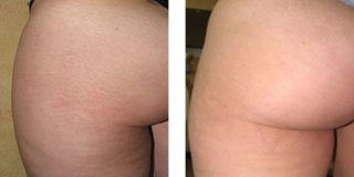 Stretch Marks on Butt Before and After Laser Treatment
