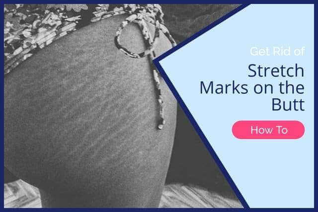 How to Get Rid of Stretch Marks on the Butt [FAST METHODS]