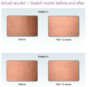 Mederma Stretch Mark Cream Before and After