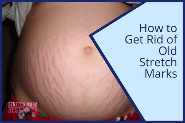 How to Get Rid of Old Stretch Marks