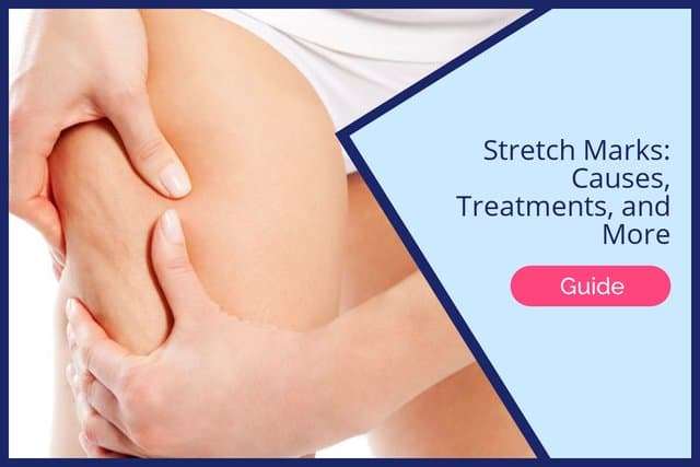 Stretch Marks Causes, Treatments