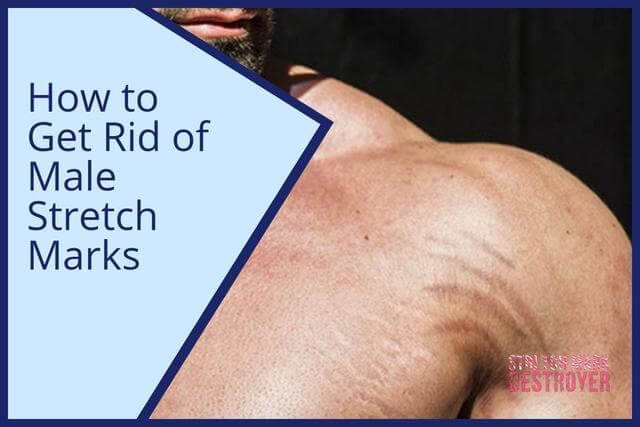 How to Get Rid of Male Stretch Marks