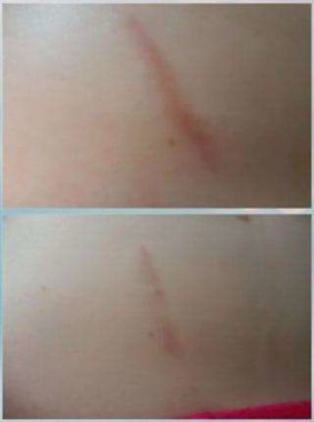 stretch marks before and after photos 2