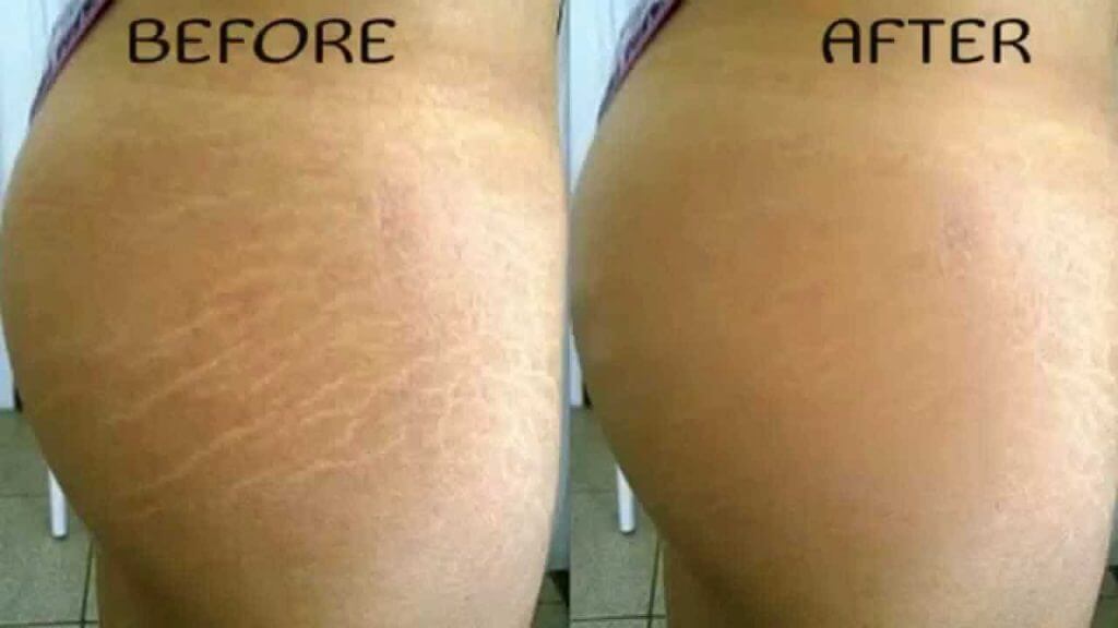 Old Stretch Mark Removal